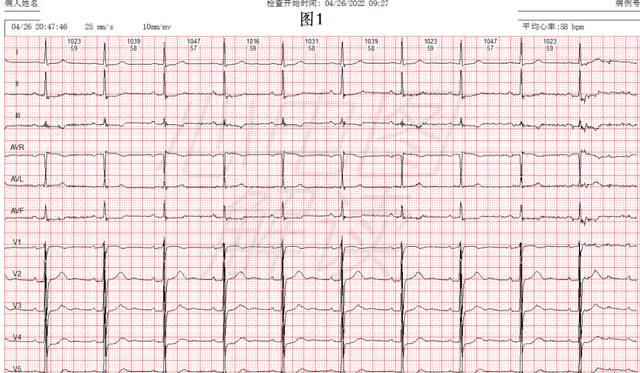 房性早搏未下传图片图片