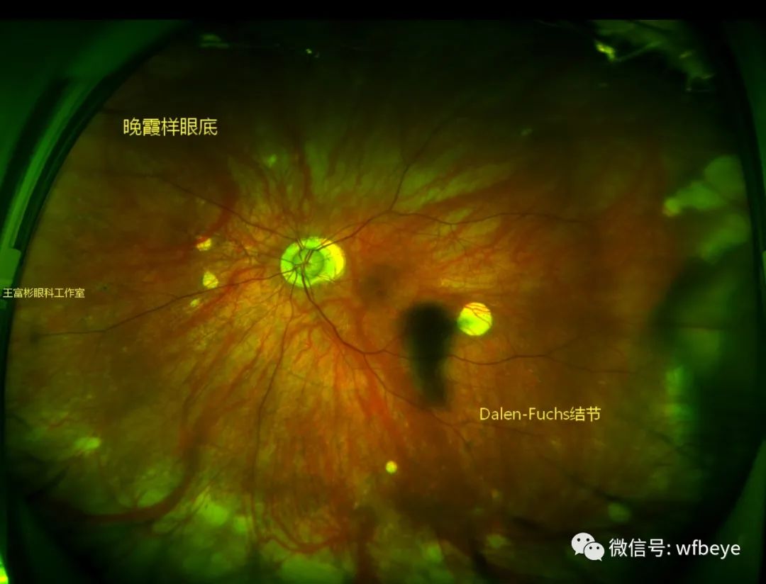 晚霞样眼底与dalen-fuchs结节,听到的多,见到的少