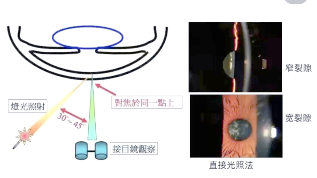 裂隙灯的多种照明方法介绍