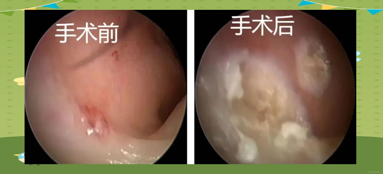 如何正确处理鼻出血?了解电凝止血的优势与操作
