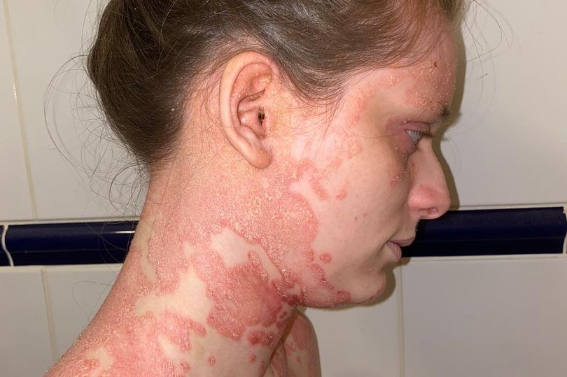 女孩患两种皮肤病 全身皮肤脱落疼痛难忍