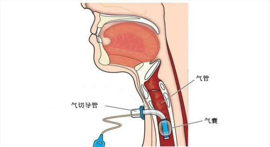 气管切开气囊放气图解图片
