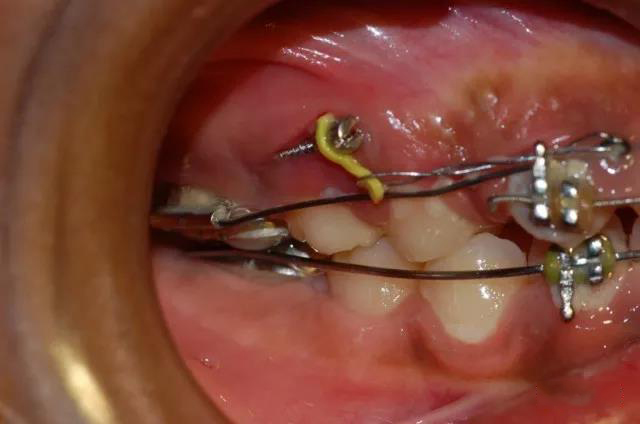 颧牙槽嵴支抗钉的植入图片