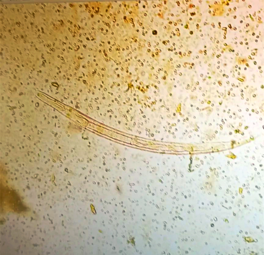 粪类圆线虫感染的检验与临床特征详细解析