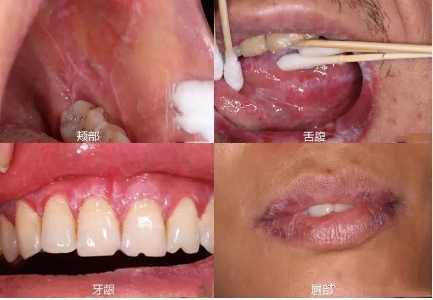 广州穗雅_得了口腔扁平苔藓饮食需注意些什么