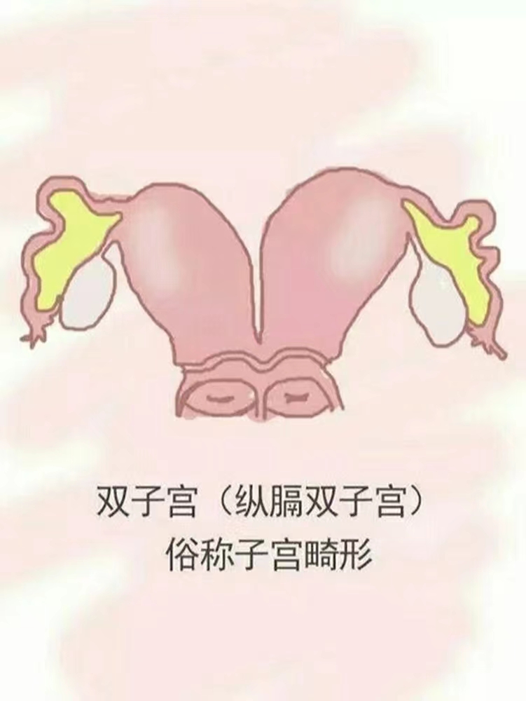 畸形子宫形态图片