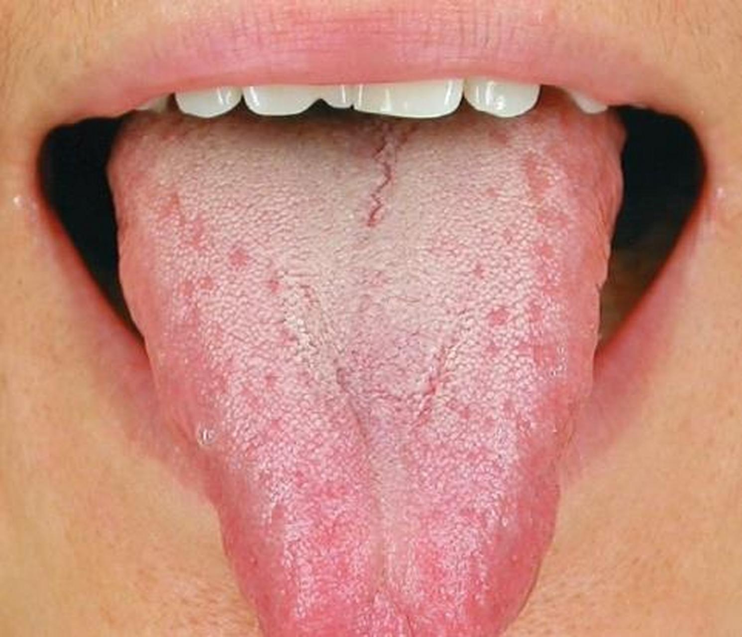 这种舌头两边鼓胀,苔白薄腻,有的人表现为v形舌,舌头细长,这类人经常