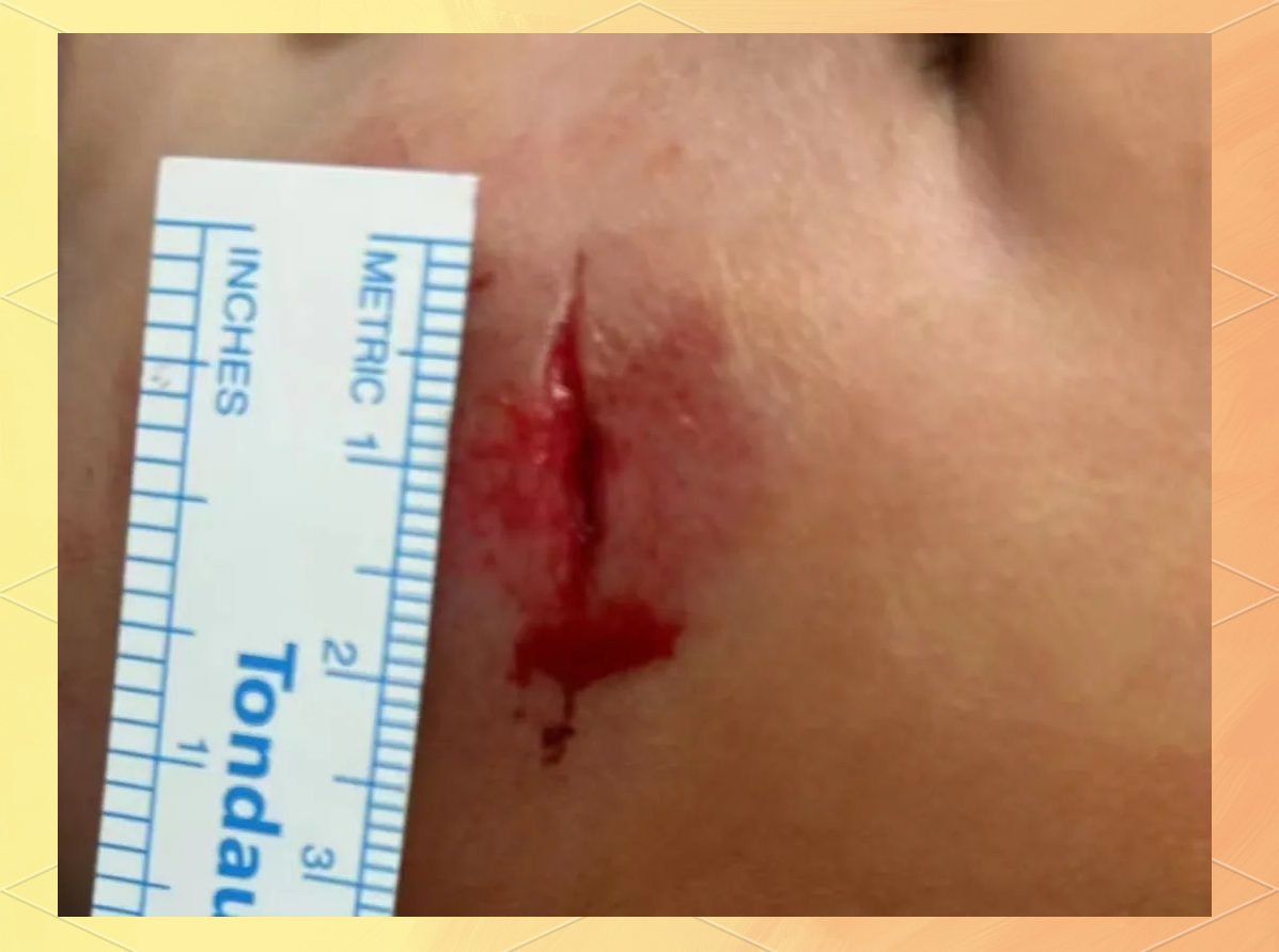 从"撒灰"到专业缝合:揭示伤口处理的科学真相与清华一附院皮肤美容科