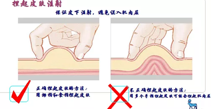 打胰岛素部位具体图片图片