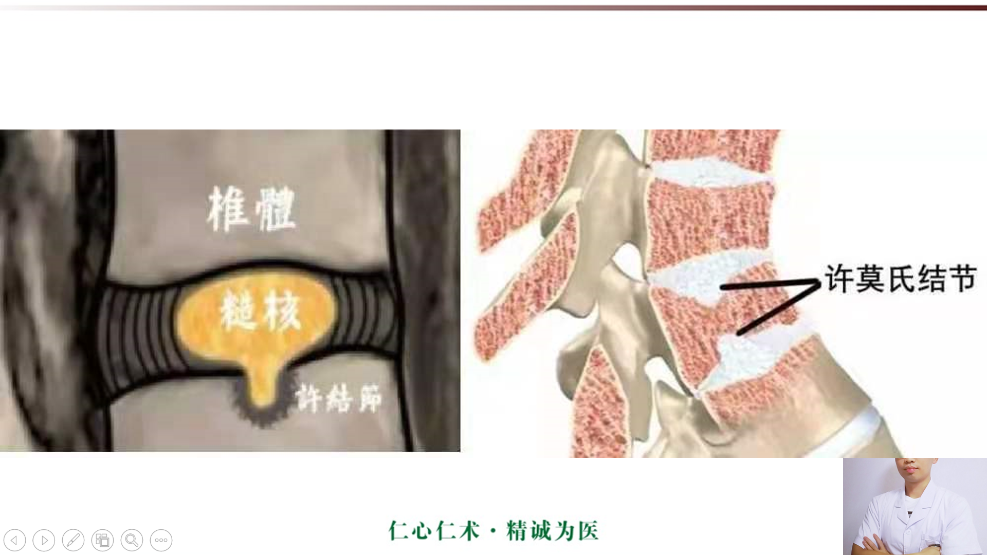 许莫氏结节及终板炎影像诊断