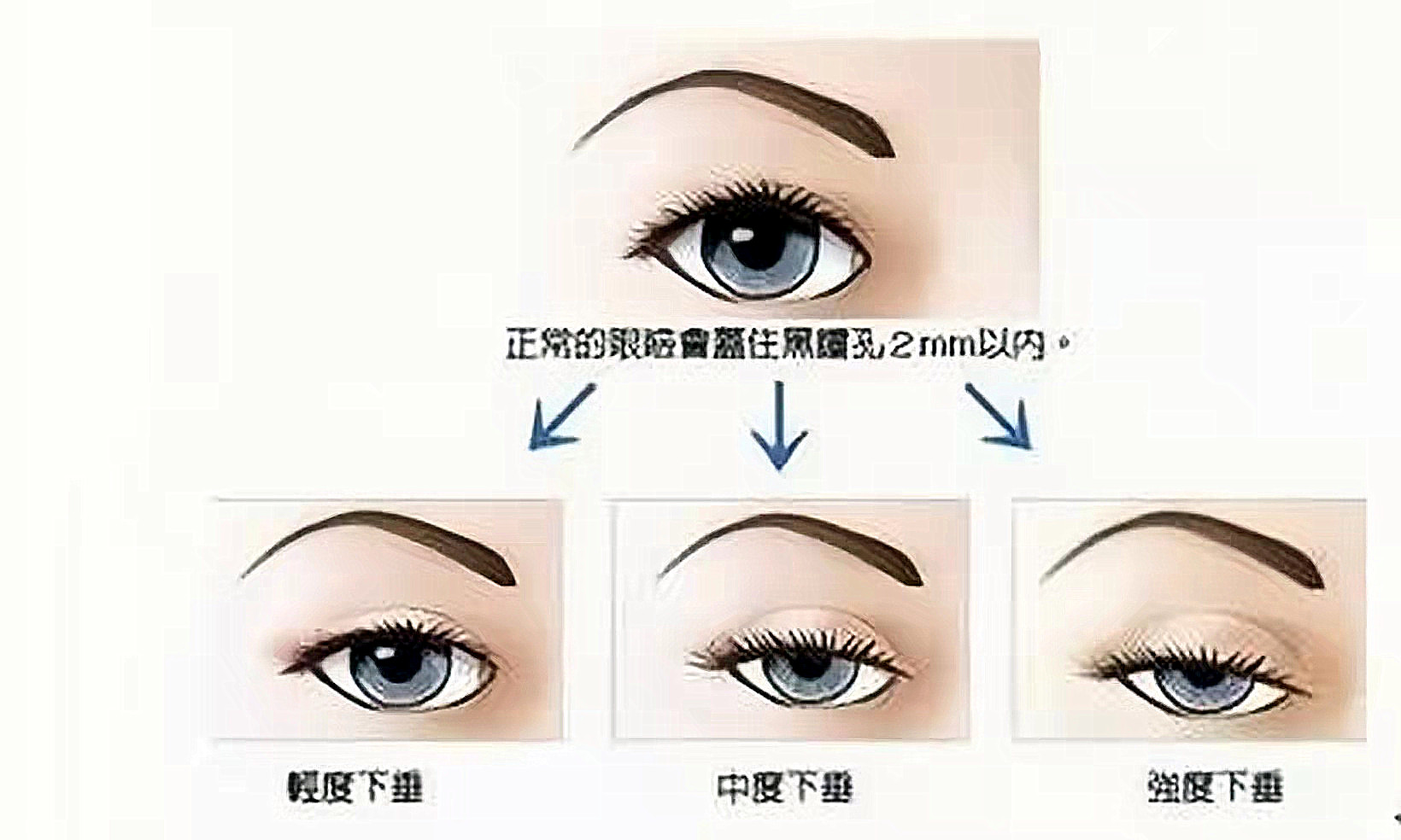 提眉可以达到整个眼周的提升吗?提眉会导致上眼皮的皱纹吗?