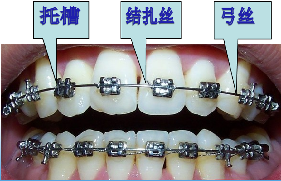 铁牙套和陶瓷牙套图片