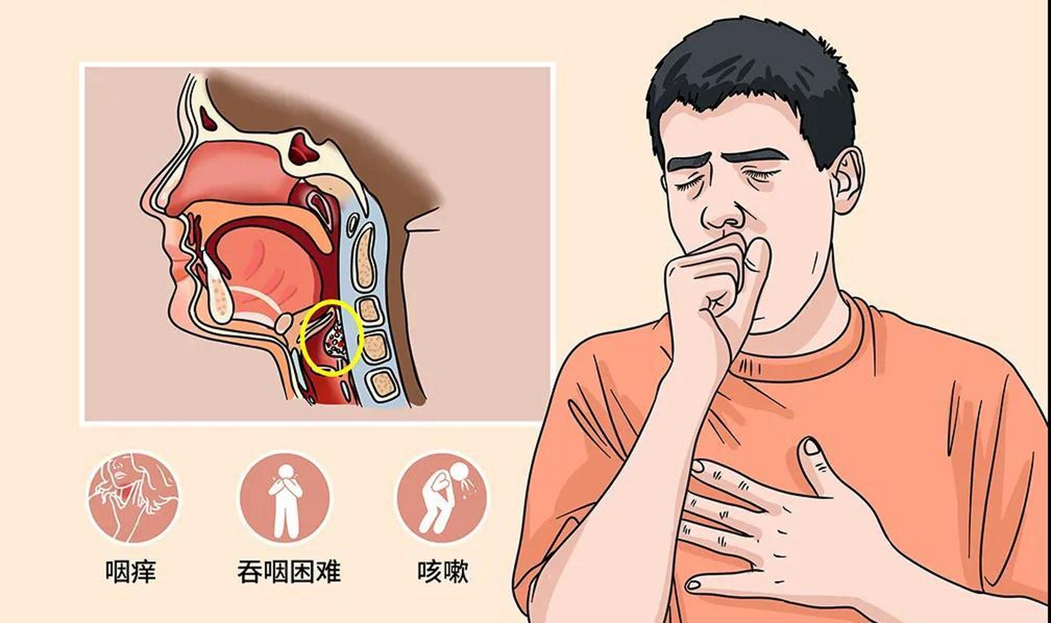 这五种情况,小心咽炎变肿瘤!