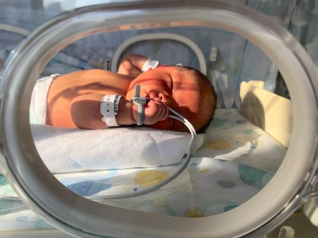 宁波超早产儿"牛油果":从手掌大小到健康成长