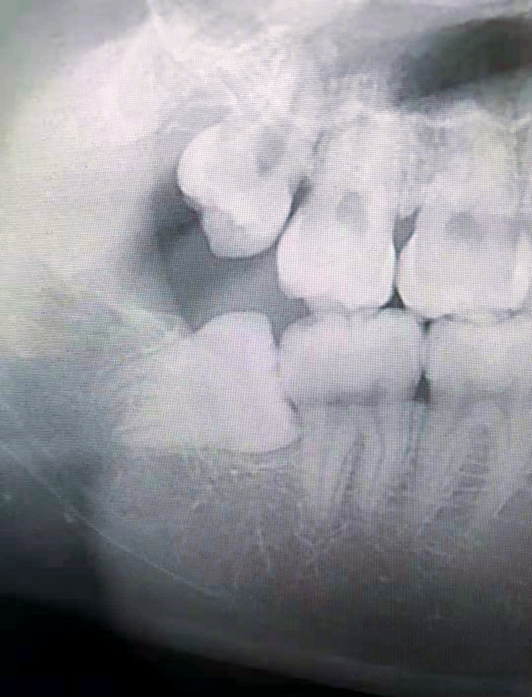 智齿为何成为牙医热衷拔除的"目标"