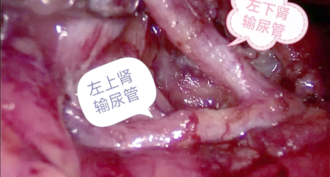 多肾脏并不一定更健康:深入探讨重复肾畸形