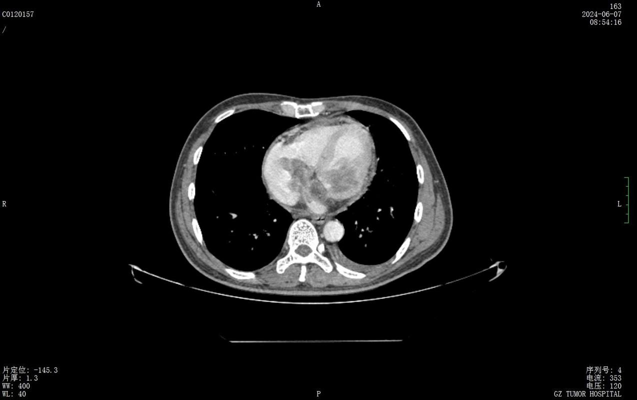 心脏室壁瘤:深入解析与防治策略