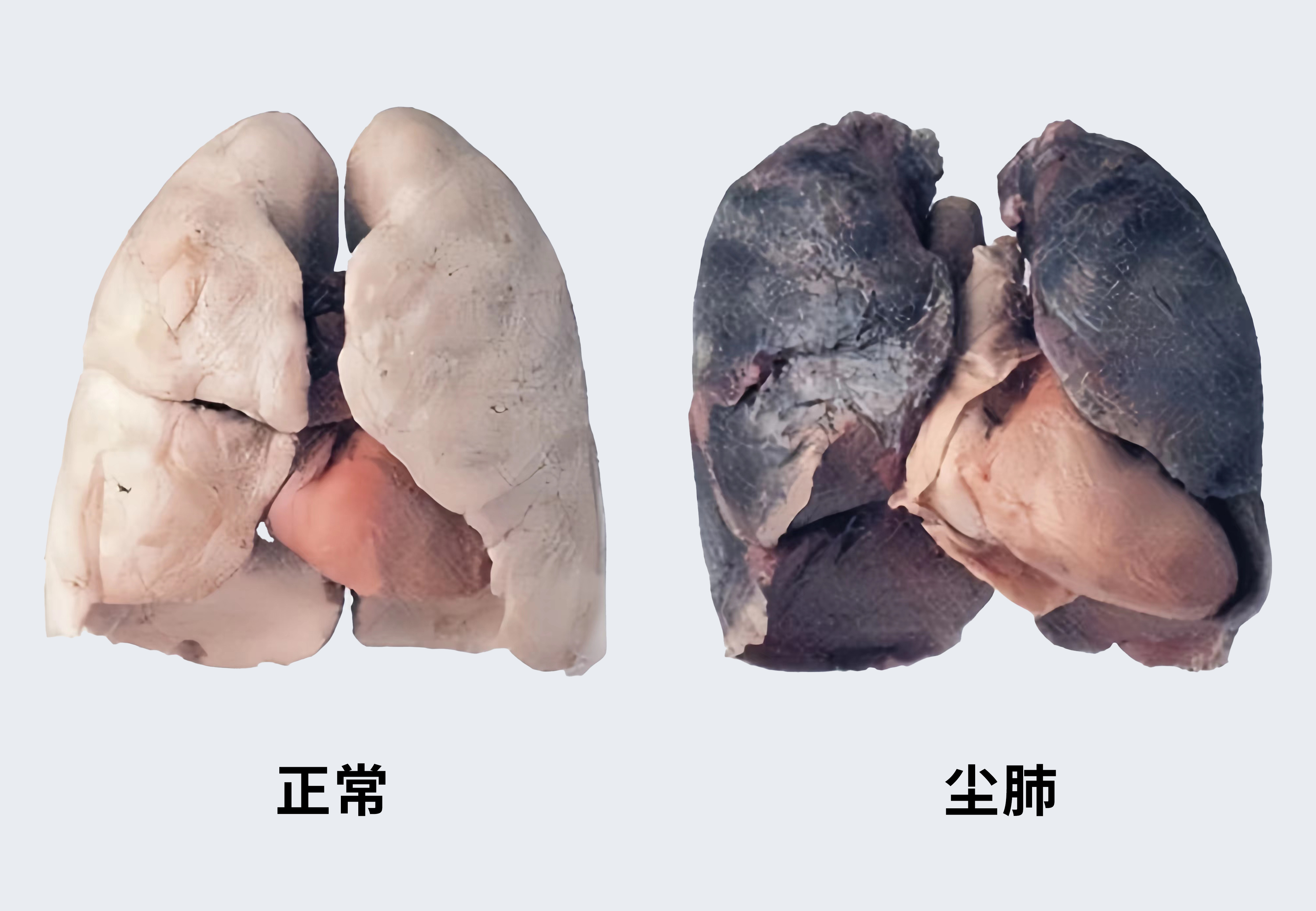 二期尘肺图尘肺病图片