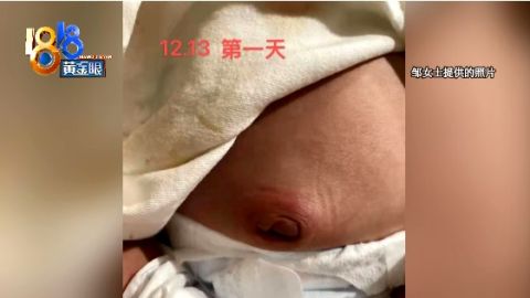 住月子中心期间得了脐炎和败血症 原因出在哪里