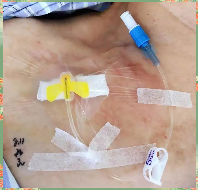 静脉输液港:一种更体贴的输液方式,你了解吗?