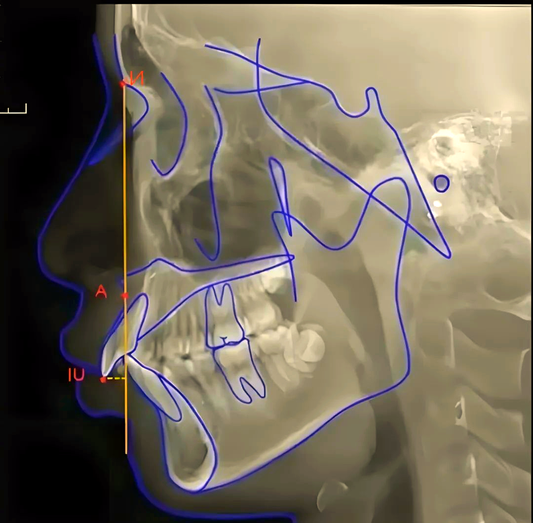 深入了解头影测量中的多种角度项目