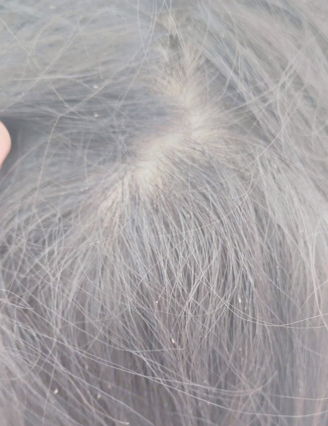 头虱感染病例介绍及防治方法概述