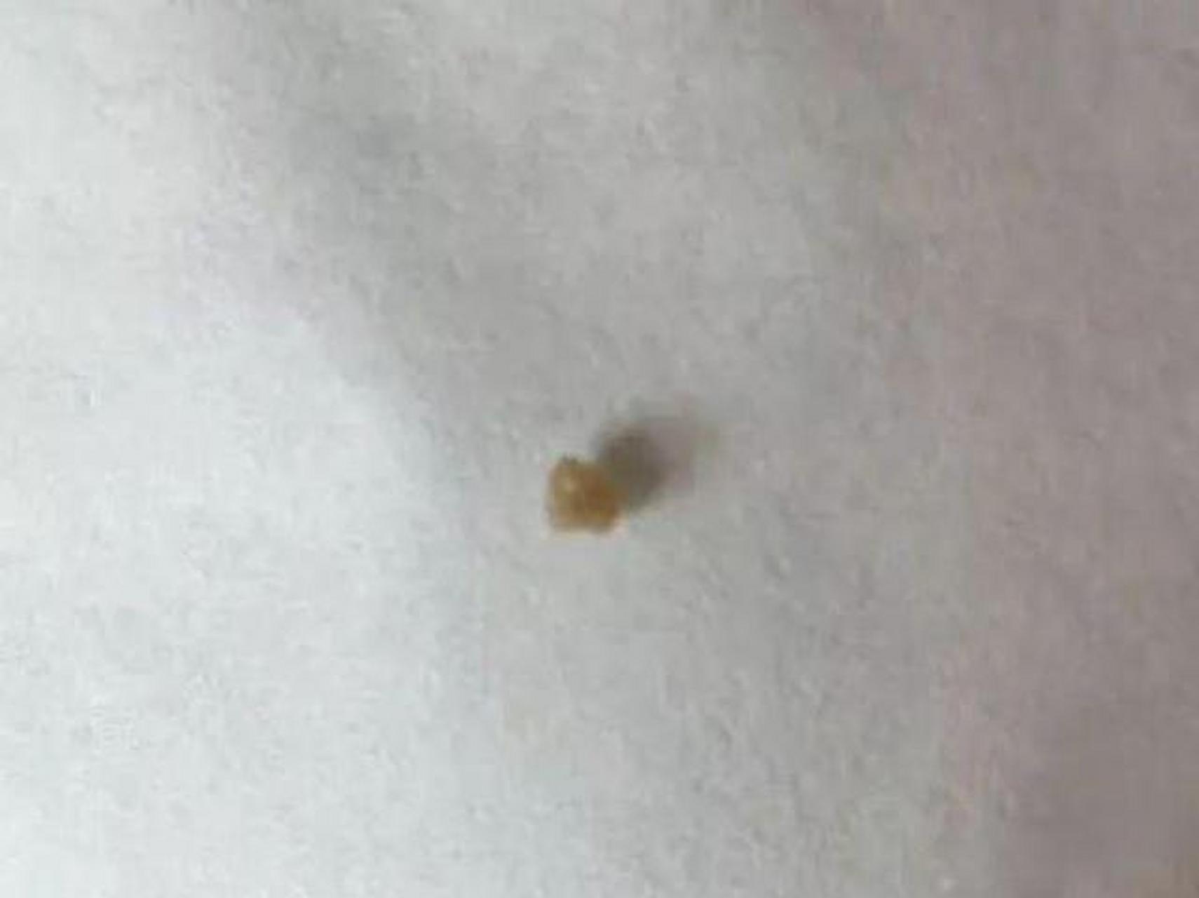 廖女士28岁,尿频尿急,与老公做完运动后,尿出石头,心中害怕,来医院