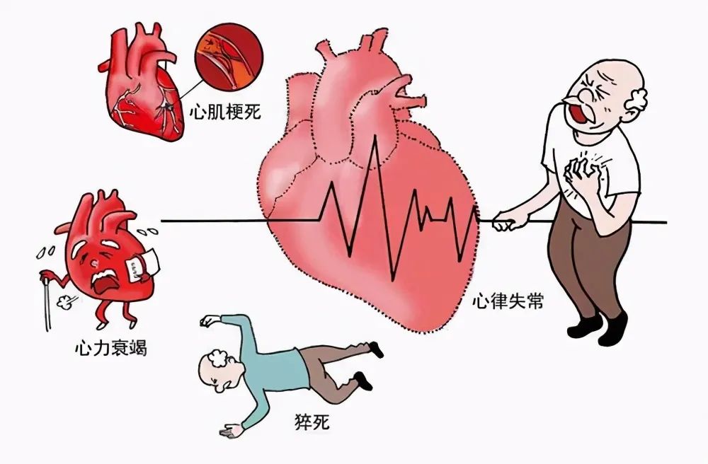 可致命的急性心梗是个什么病?看完这篇文章就知道了!