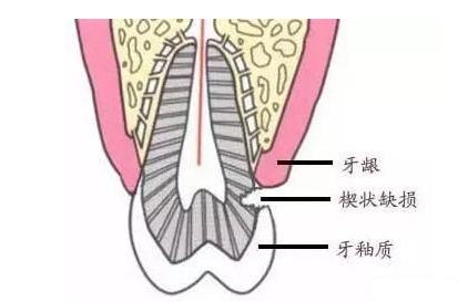 沟牙和管牙的区别图片