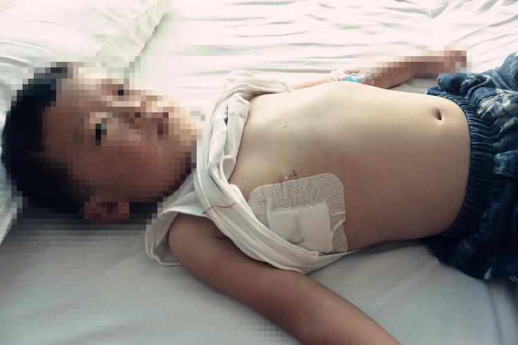 如何判断和治疗鸡胸病?专家为您解答