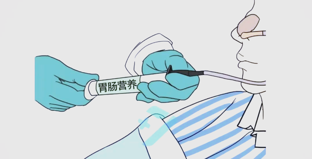 留置胃管的操作与护理指南