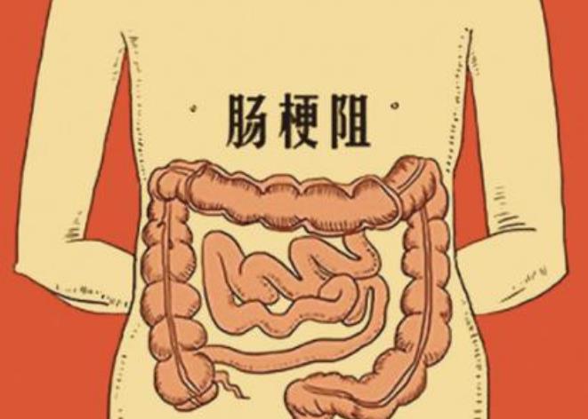 想知道如何治疗肿瘤性肠梗阻?这篇文章告诉你!