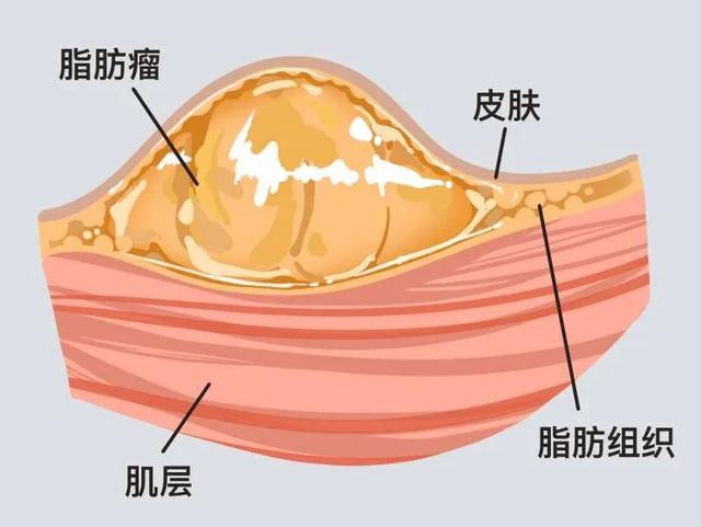 按摩致"脂肪瘤"破裂进icu!医生:这4种建议切除