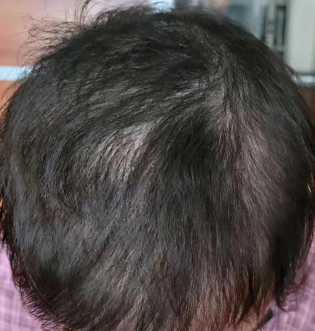 拔完越来越痛苦!14岁漂亮姑娘硬生生把自己拔成秃顶,医生找到原因