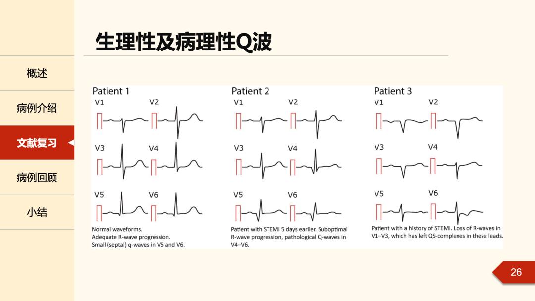 异常q波心电图怎么看图片