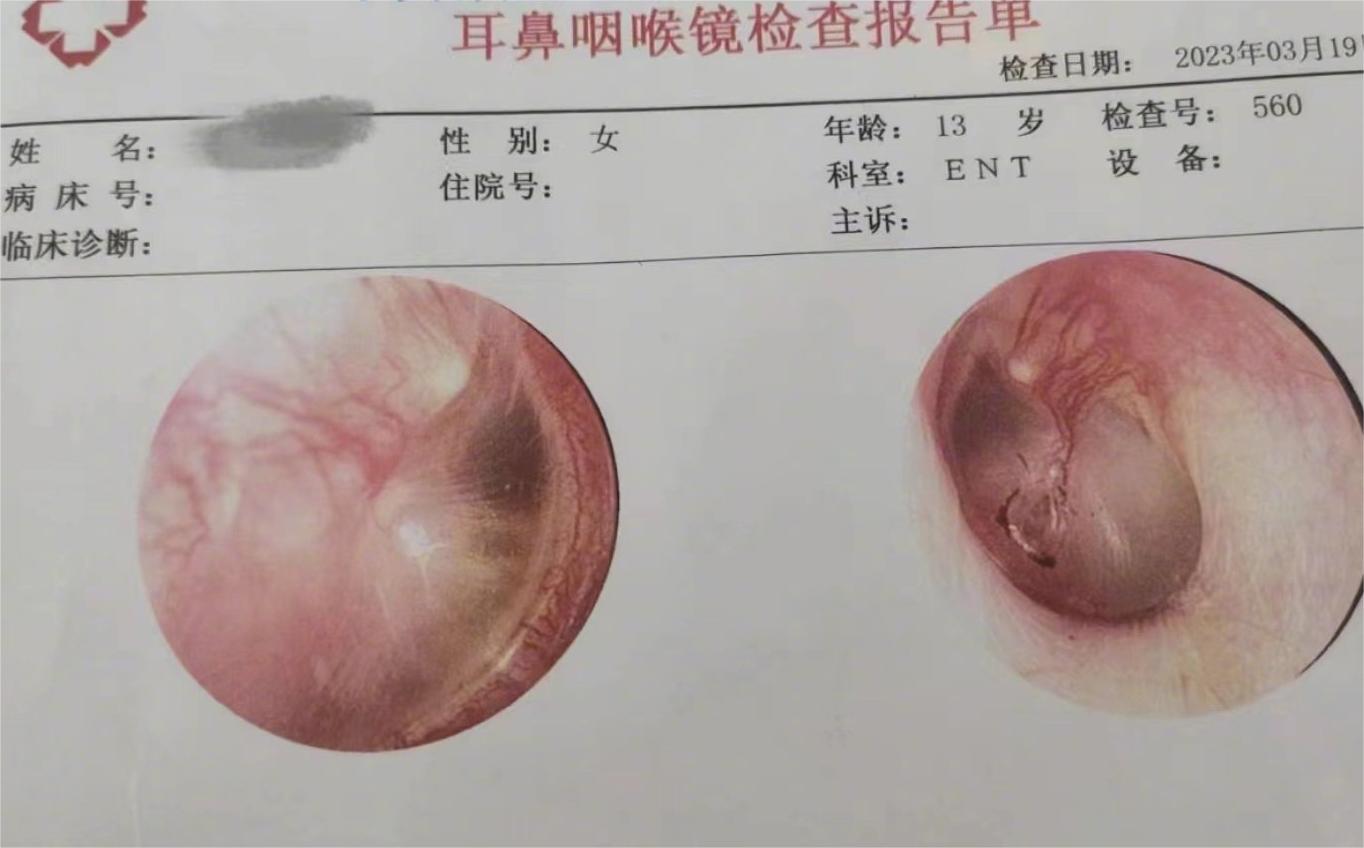 耳膜塌陷图片