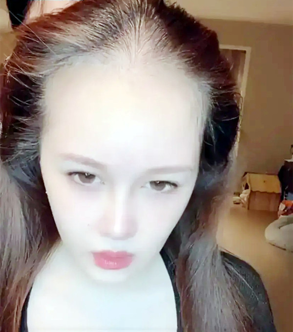 赵本山女儿近照吓坏网友 脱发严重酷似"裘千尺"