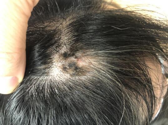 头皮黑斑切莫忽视,鼓楼医院恶黑多学科团队联合诊治35岁恶性黑色素瘤