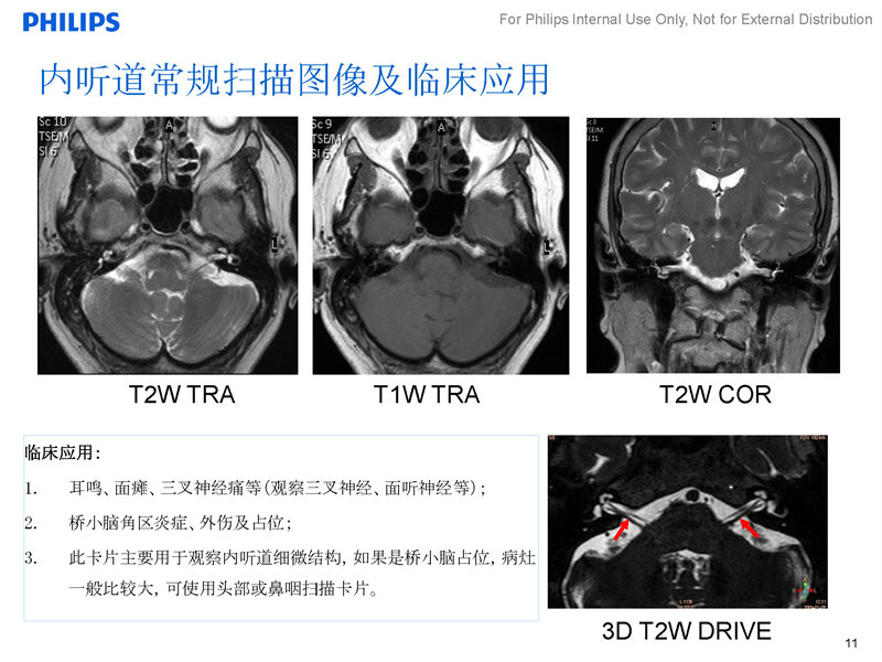 内听道磁共振图片