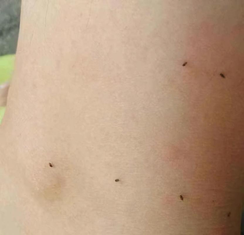 夏季公园小黑虫叮咬:原因与防范策略