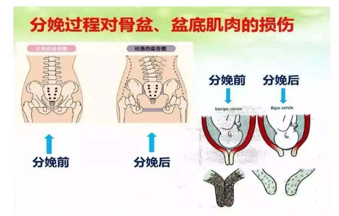笑尿了可能是你的盆底出问题了锻炼盆底肌这几招管用