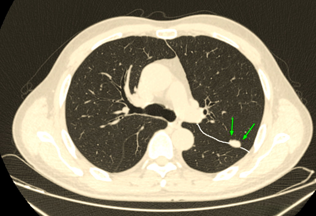 肺结节影像特征与处理建议