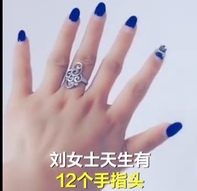女子天生12根手指,自嘲六指琴魔,网友:毫无违和感
