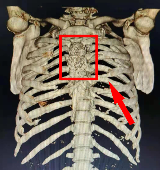 川東北首例!男子患胸骨腫瘤,3d打印出