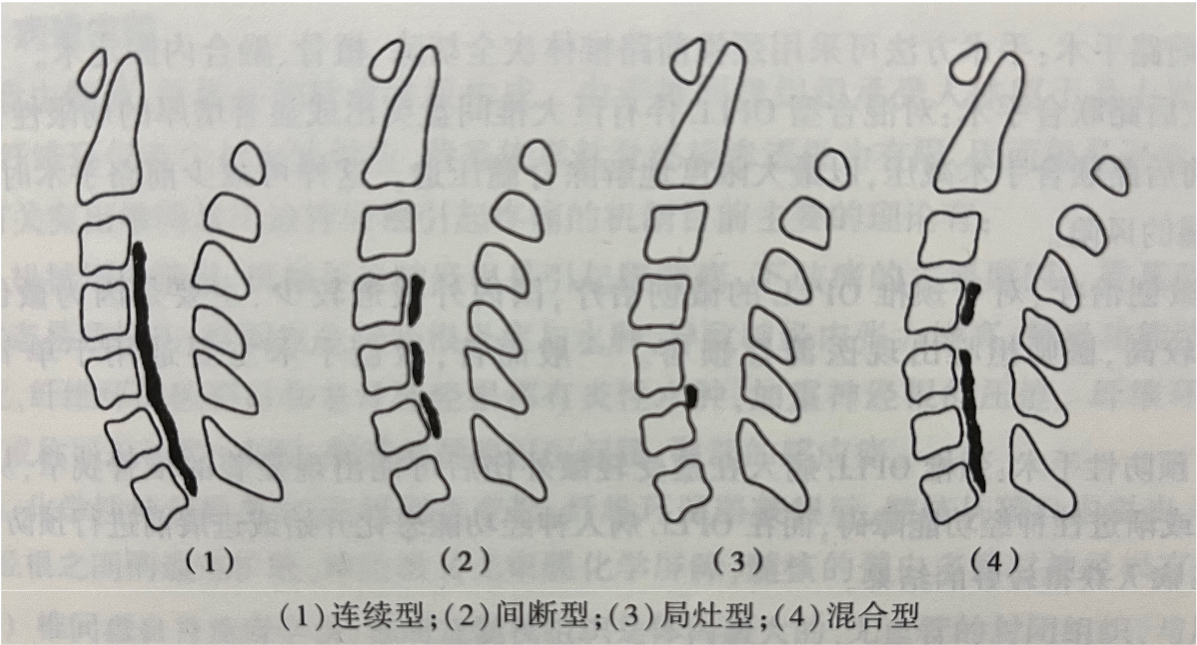 颈椎纤维环图片