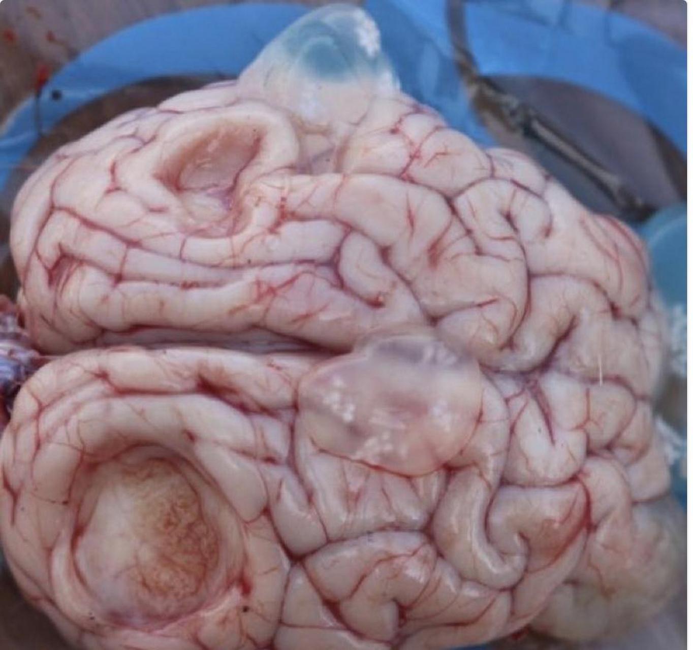 寄生虫导致的脑囊肿