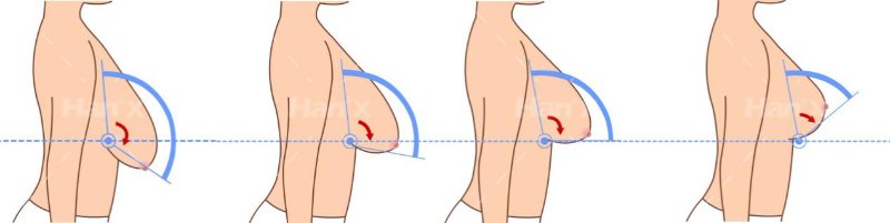 乳房提升术后悔了?试试不切开的人工韧带法