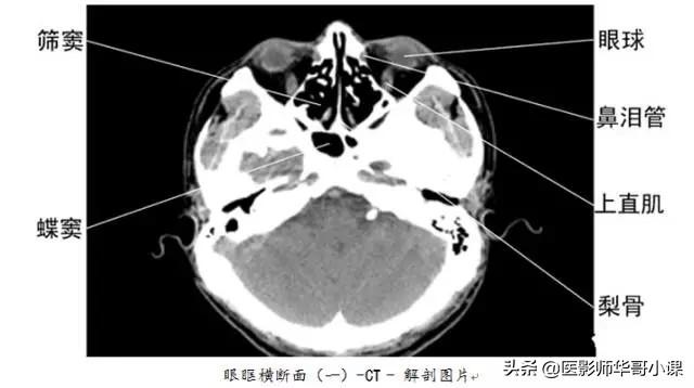 「高清ct图」头颅,胸部和腹部ct解剖图谱