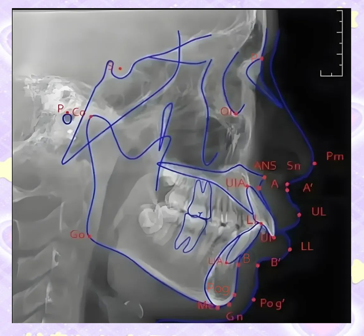 掌握头影测量定点技巧,轻松搞定口腔正畸方案