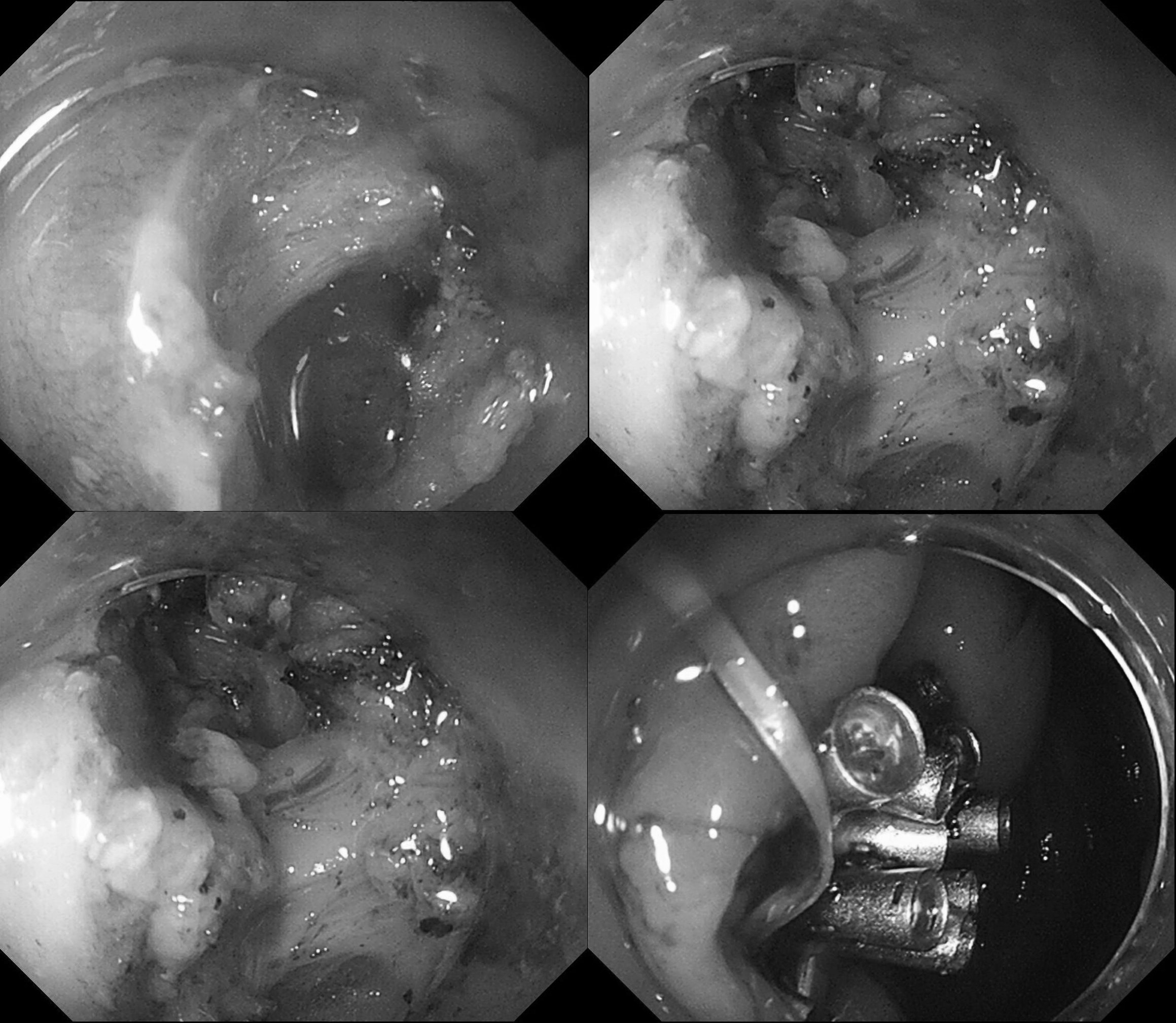 中国医大一院成功完成内镜下经盲肠阑尾切除术